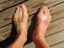 5 Cemilan Ini Ternyata Bisa Turunkan Asam Urat, Apa Saja?